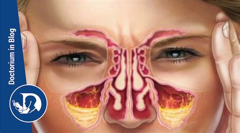 Cos’è la sinusite cronica? Sintomatologia e trattamento | doctorium.it