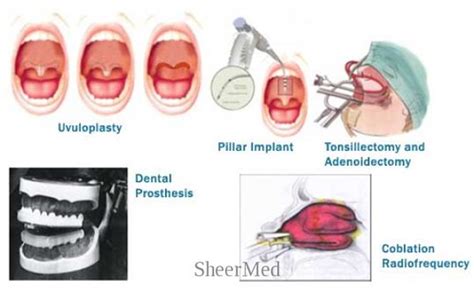 Adenoidectomy | Adenoidectomy is the surgical removal of the… | Flickr