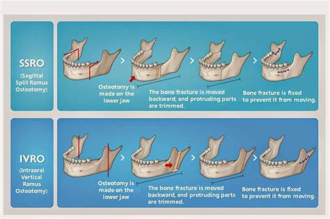 Sagittal Split Ramus Osteotomy