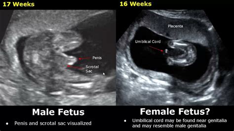 24 Weeks Ultrasound Gender