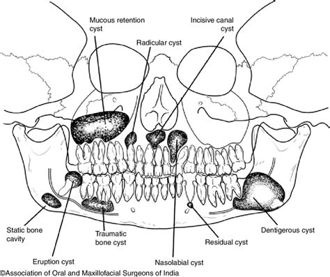 4 Typical locations of odontogenic and nonodontogenic cysts | Download Scientific Diagram