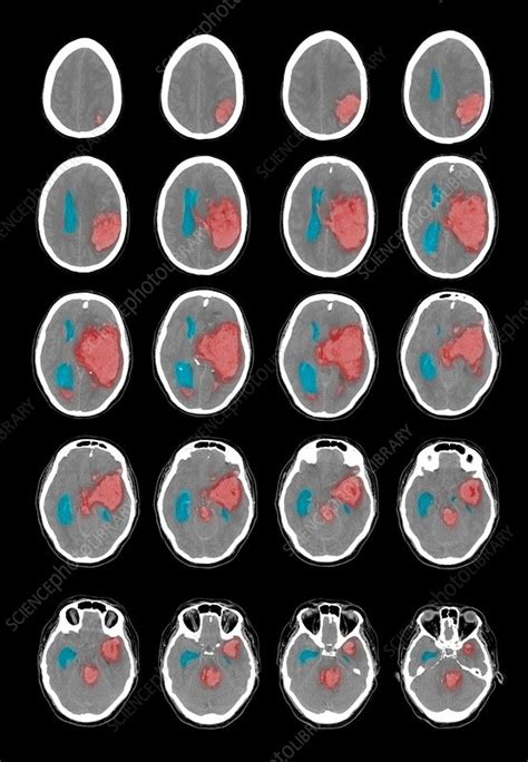 CT Scan of Intracranial Hemorrhage - Stock Image - C003/4548 - Science Photo Library