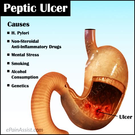 Peptic Ulcer: Treatment, Causes, Symptoms, Types, Tests