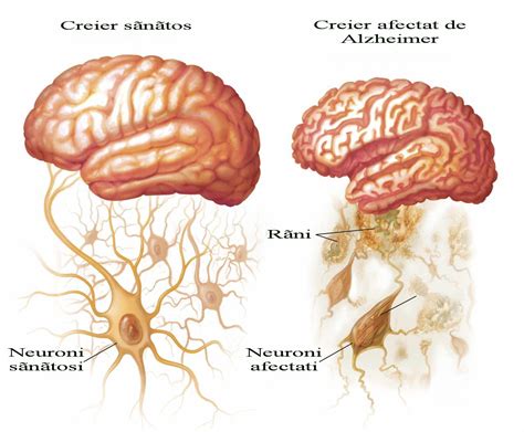 Alzheimer (boala) | Referate