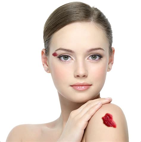 Red Birthmarks - Laser Clinic Galway