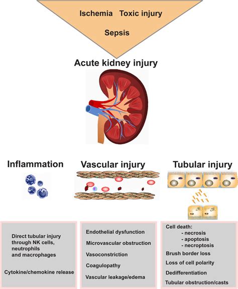 Pathogenesis Of Acute Kidney Injury