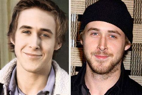 ryan gosling plastic surgery | Nose job, Plastic surgery, Celebrity plastic surgery