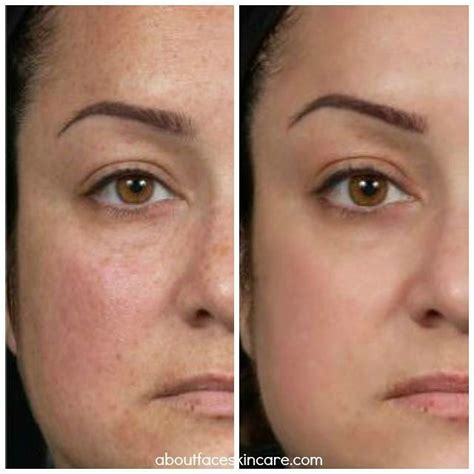 About Face Skin Care on Instagram: “A before and after showing the effectiveness of Clear ...