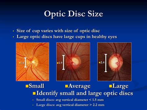 PPT - Fine Tuning Glaucoma Diagnosis and Management in Haiti PowerPoint ...