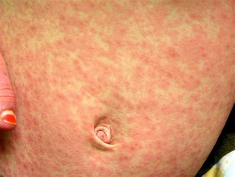 HealthoolRubeola (measles, first disease) Rash Pictures Atlas of Rashes Associated With Fever A ...