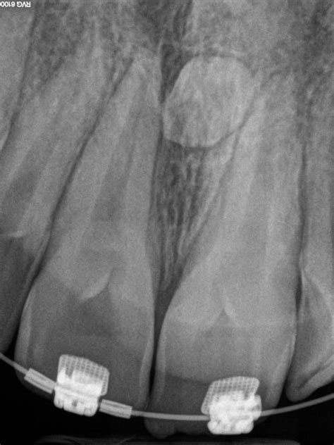 Mesiodens - Supernumerary tooth (hyperdontia) - Bauer Smiles