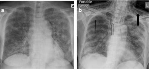 a Chest X-ray on admission showing bilateral peri-hilar interstitial... | Download Scientific ...