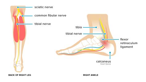 Tarsal tunnel syndrome: symptoms, reasons and treatment. — Your Health