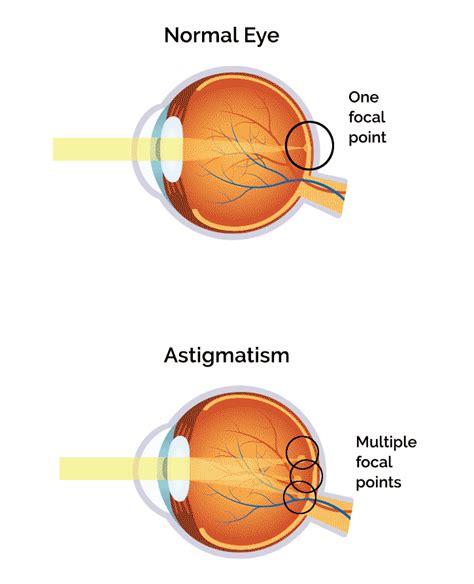 Astigmatism Diagnosis & Treatment in Mid-West | Memorial Eye Center ...