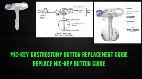 How to Change the Mic-Key Button G-tube mic-key gastrostomy button replacement