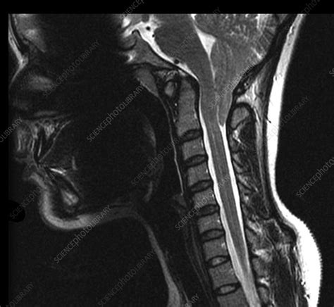 MRI of Severe Chiari I Malformation - Stock Image - C027/1656 - Science ...