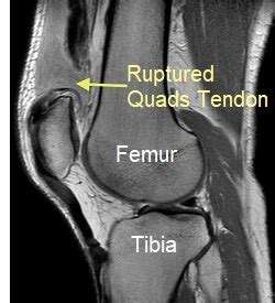 Quadriceps Tendon Rupture - Knee Pain Explained