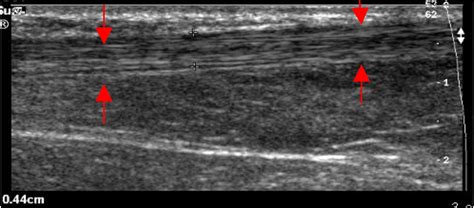 emDOCs.net – Emergency Medicine EducationUltrasound for Achilles Tendon Rupture - emDOCs.net ...