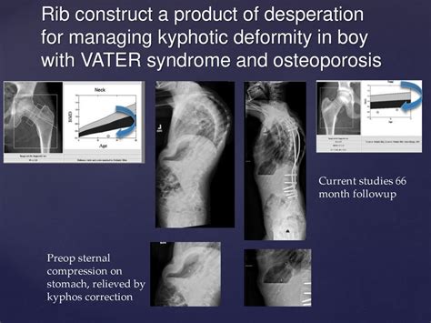 Kyphosis and Implantation: Modeling a Clinical Phenomenom - ppt download