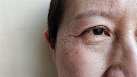 Ptosis: Types, Symptoms, Causes, Diagnosis, Treatment and More