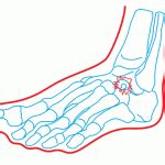 Sinus Tarsi Syndrome | Dr the Foot Without the Dr