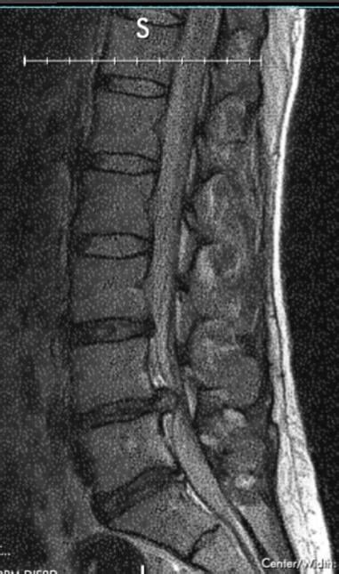 Got a better look at my MRI and am not sure what to think : r/Sciatica