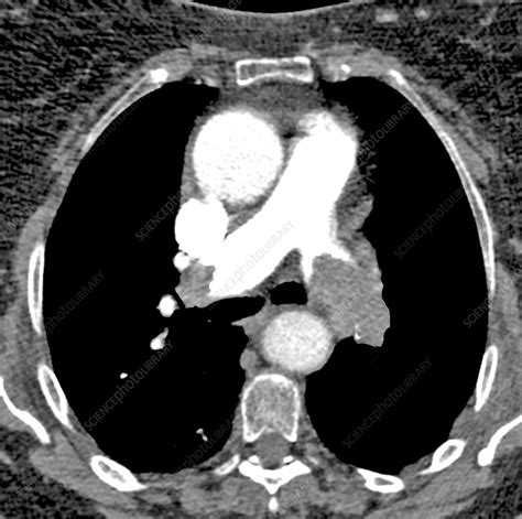 Pulmonary embolism, axial CT scan - Stock Image - C048/6095 - Science Photo Library