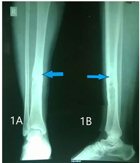 Cureus | A Case Report of Salmonella Typhi Osteomyelitis With ...