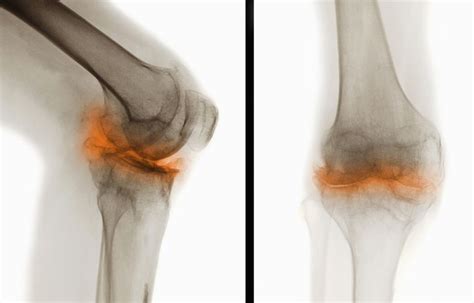 Overview of Osteoarthritis With Pictures