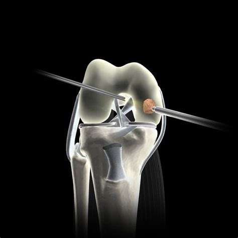 Articular Cartilage Repair Options for Arthritic Knees