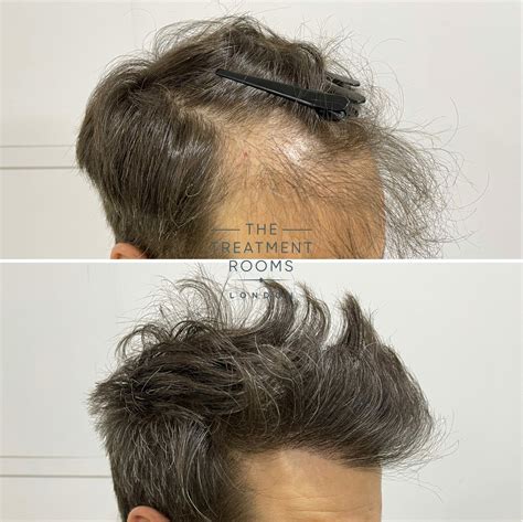 Top 103+ Direct hair transplant cost - Eastonmainstreet.com