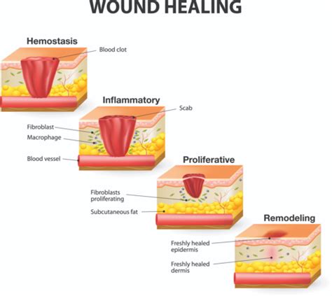 Granulation Tissue Is Best Described as Quizlet