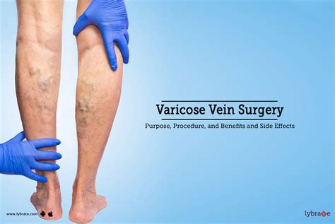 Varicose Veins Surgery: Purpose, Procedure, Benefits and Side Effects