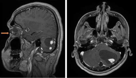 MRI evaluation of pediatric posterior fossa tumors and its correlation ...