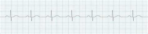 Difference of these two 12 lead monitoring? | EMTLIFE