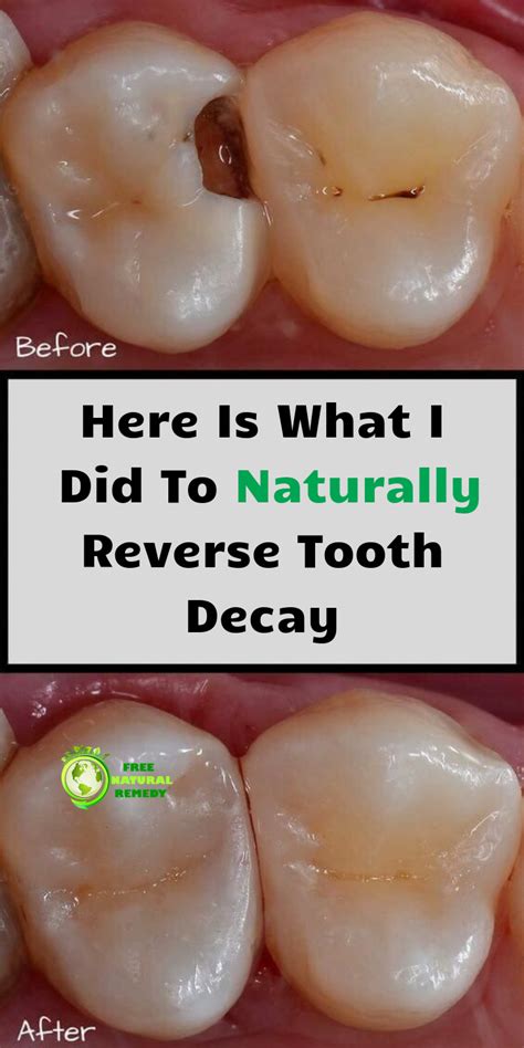 Here Is What I Did To Naturally Reverse Tooth Decay. in 2020 | Tooth decay remedies, Heal ...