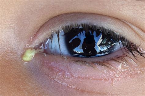 What Causes Blepharitis and Everything Else You Need to Know