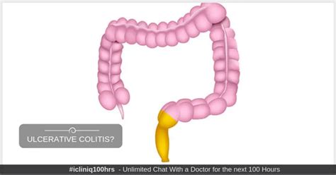 Ulcerative colitis with bleeding in stool