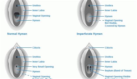 Hymen – appearance, functions. Break of the hymen – Healthy Food Near Me