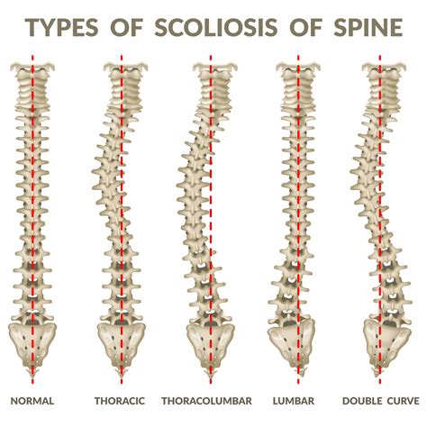 What if my child has scoliosis? - Palermo Physiotherapy & Wellness Centre Oakville