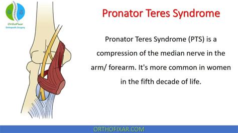 Pronator Teres Syndrome | OrthoFixar 2025