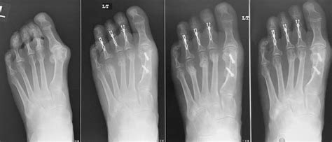 Minimally Invasive Metatarsal Osteotomy (DMMO) | Peter Rosenfeld FRCS ...