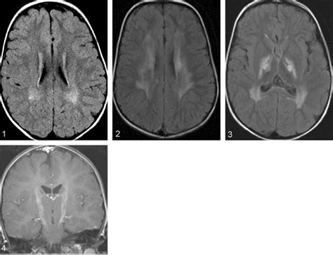 Follow-up MR image, revealing increase in the periventricular white... | Download Scientific Diagram