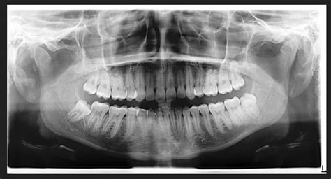 Why is a Panorex x-ray needed before wisdom teeth extractions? | Why is ...