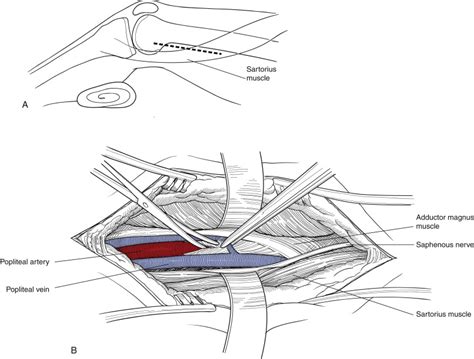 Open Surgical Bypass of Femoral-Popliteal Arterial Occlusive Disease | Thoracic Key