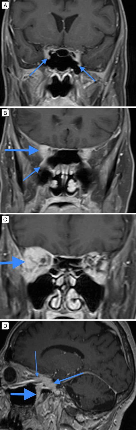 Fat-suppressed, T1-weighted MRI sequence with gadobutrol. A, Coronal... | Download Scientific ...