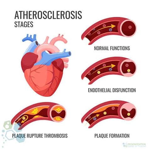 Stem Cell Therapy for Heart Disease Atherosclerosis CAD IHD