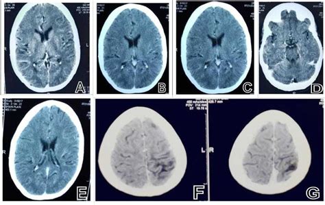 When a plain CT brain looks like contrast-enhanced- never forget polycythemia | BMJ Case Reports