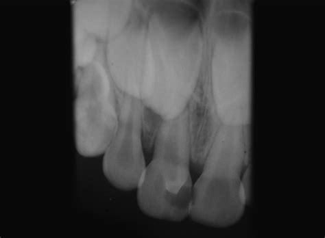 Radiographic view of talon cusp | Download Scientific Diagram