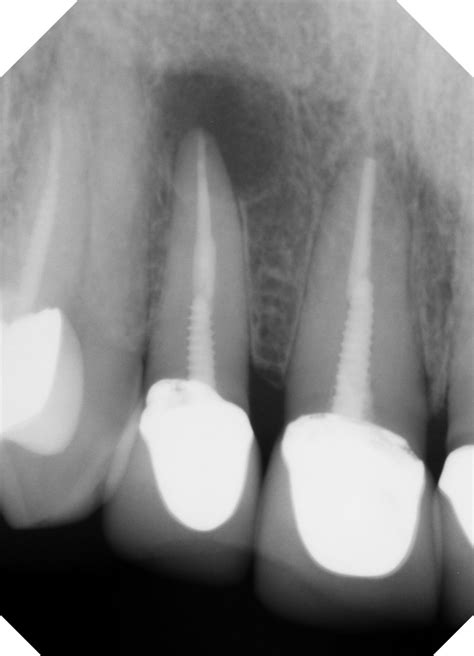 Root Canal Missoula | Endodontics MT | Root Canal Procedure 59803 ...